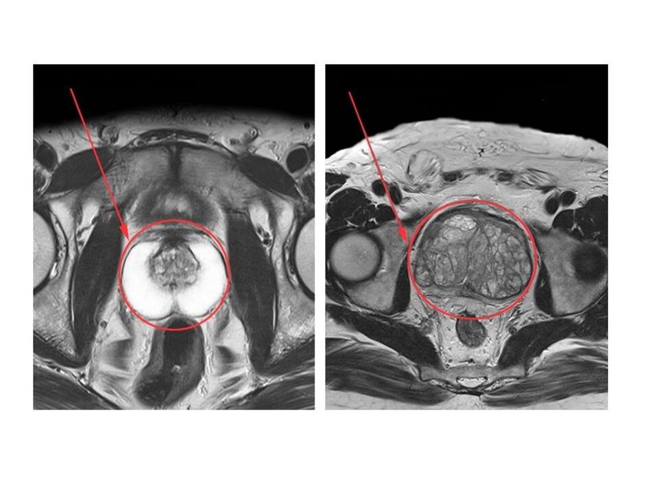 Usporedba zdrave (lijevo) i upaljene (desno) prostate na MRI slikama